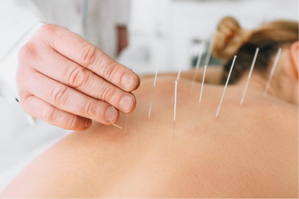 DRY-NEEDLING-THERAPY